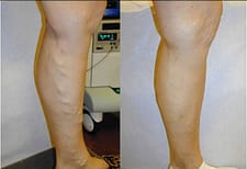  Varicose veins