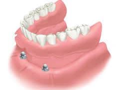 dental implants